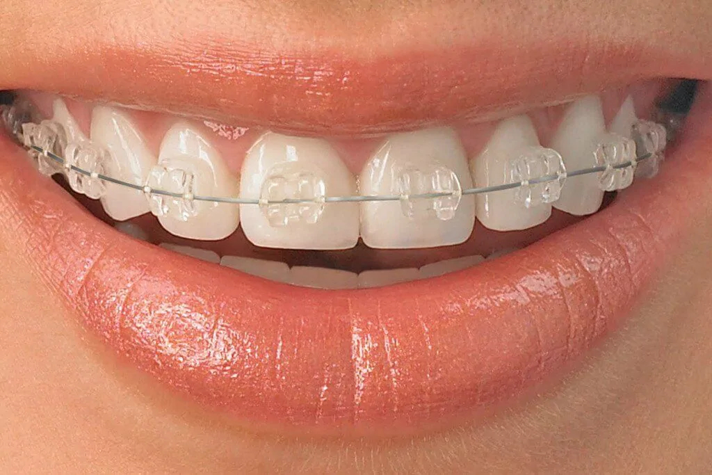 HOME 27 ceramic-braces-663385818ac09