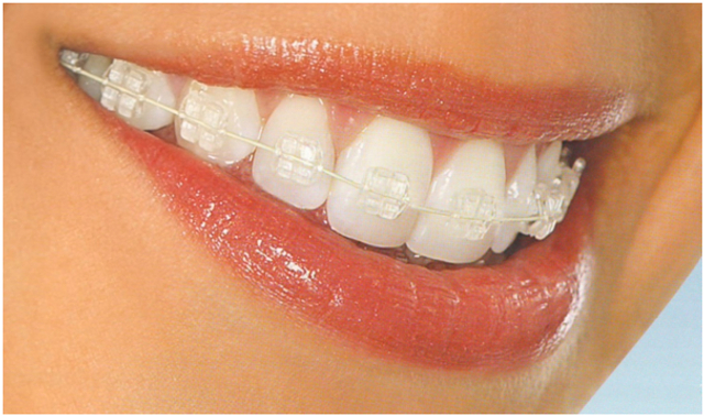 HOME 30 clear-braces-663385828e613